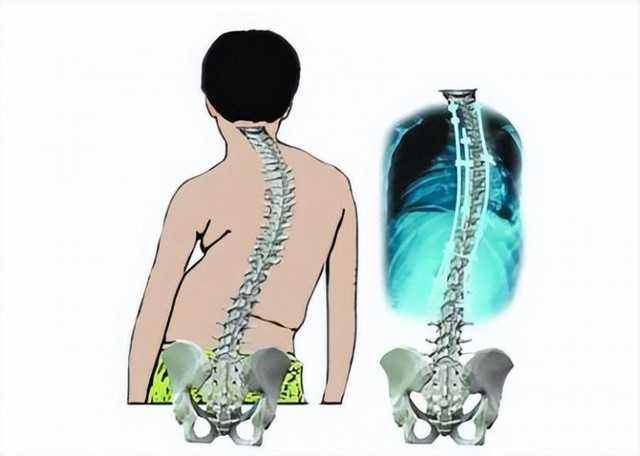 周杰伦脊椎炎是什么病（困扰周杰伦的强直性脊柱炎）