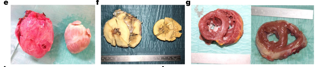 全球首例！美国57岁男子成功移植转基因「猪心」，异种移植再创奇迹