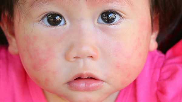 患有生殖性疱疹可以母乳喂养