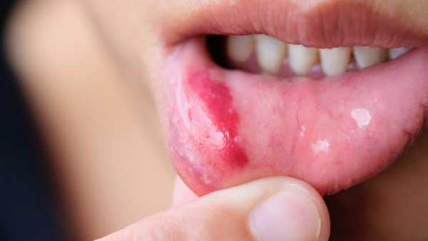 白血病引起的口腔溃疡和普通口腔溃疡的区别有哪些