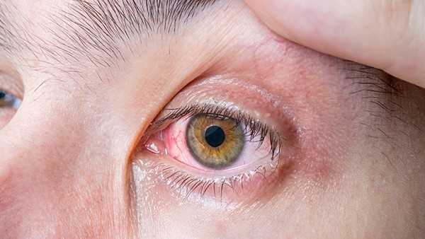 白眼球黄是怎么回事，和肝有关系吗