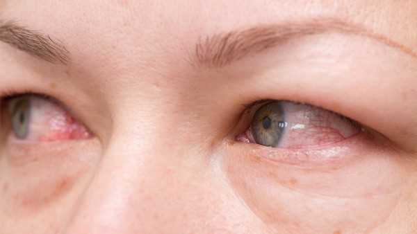 衣原体性结膜炎用什么眼药水
