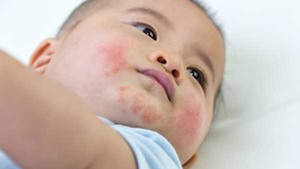 婴儿湿疹不含激素的药膏有哪些