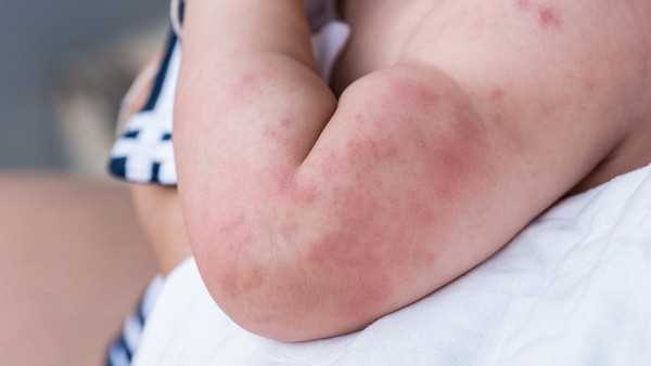 丘疹过敏性荨麻疹病因和治疗方式是什么