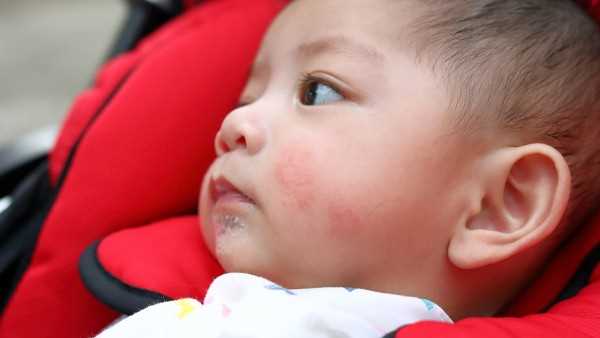 三个月的宝宝起湿疹还可以打预防针吗，怎么办