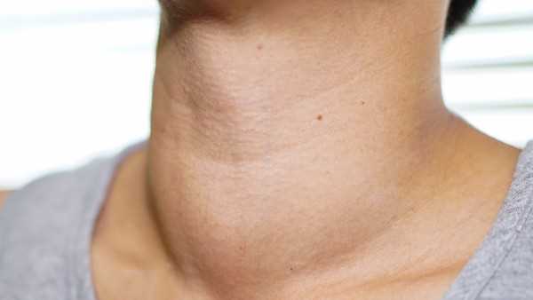 甲状腺结节患者嗓子会疼吗