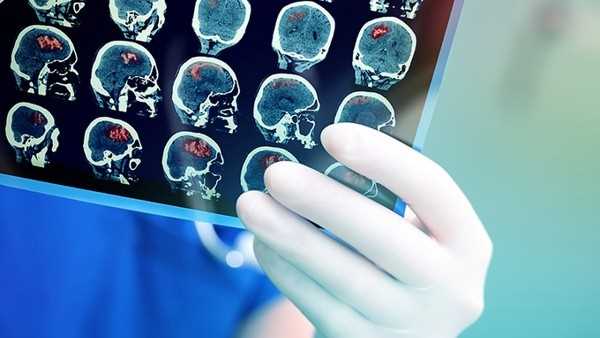 孩子做CT对大脑有影响吗