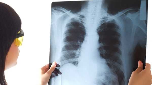 肺癌晚期会传染吗，对身边的人有影响吗