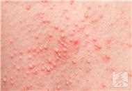 湿疣疱疹具有的症状是什么