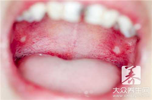 口腔溃疡频繁发作的原因