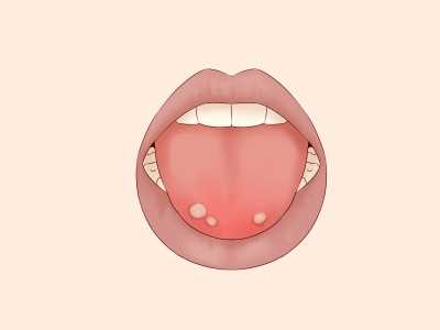 嘴巴里面起泡是什么原因