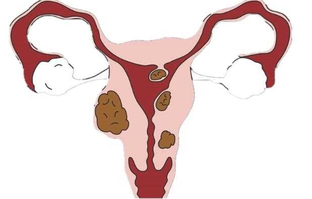 卵巢癌如何引起的？如何预防卵巢癌？