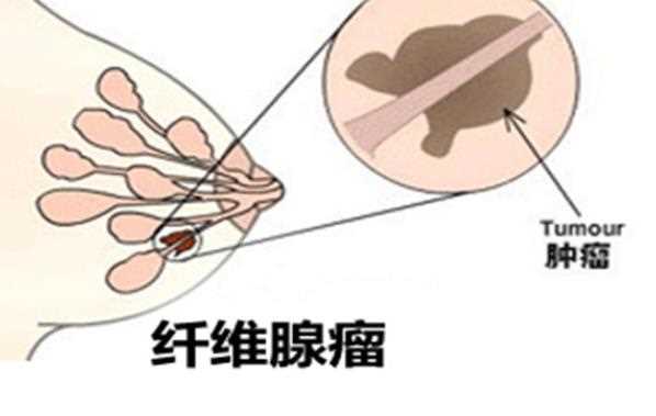 乳腺纤维瘤有哪些症状 包块局部刺痛表面光滑易推动
