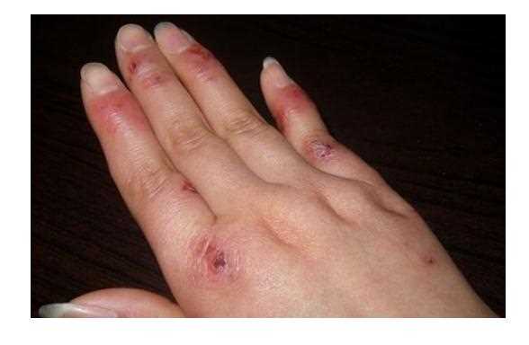 手冻伤了怎么办？手冻伤如何预防与护理？