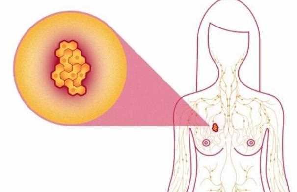 乳腺结节是什么原因导致的 