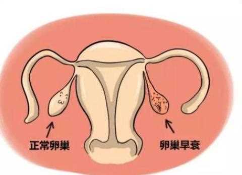 卵巢早衰是什么原因 卵巢早