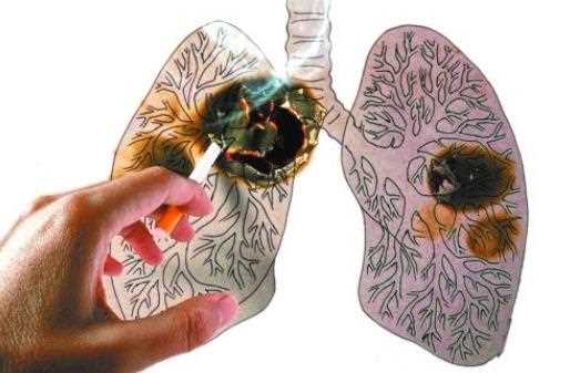 肺癌是什么原因引起的 肺癌