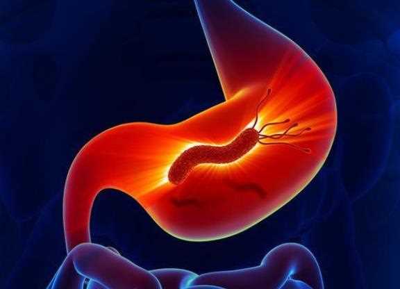 幽门螺杆菌会影响肠道吗 刺激胃肠道导致感染腹泻