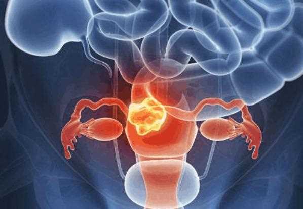 卵巢癌需要切除吗？影响卵巢癌晚期存活的因素？