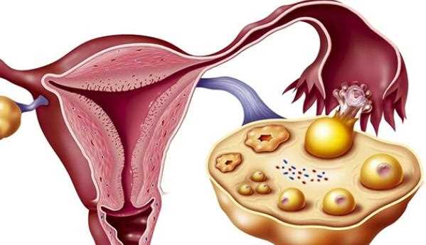 卵巢早衰怎么办 卵巢早衰致不孕怎么办