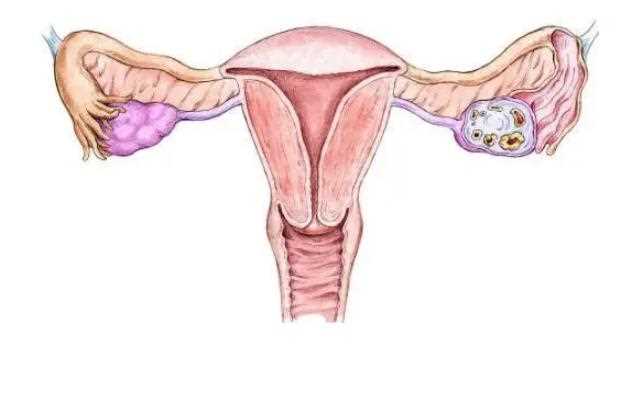 卵巢囊肿是指卵巢癌吗？做家务
