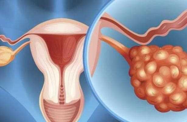 卵巢囊肿影响怀孕吗 卵巢囊