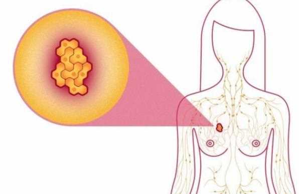 乳腺增生有哪些危害 乳腺增生可以根治吗