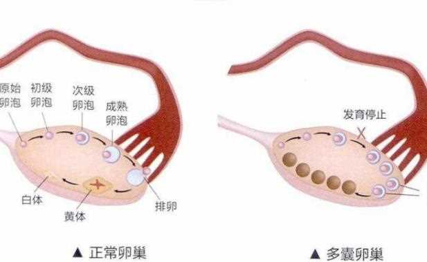 什么是多囊卵巢综合征 多囊