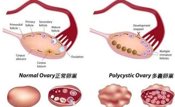 多囊卵巢综合征会闭经吗 多囊卵巢综合征可以做试管