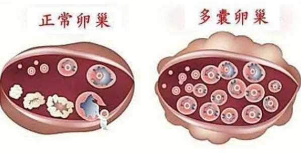 多囊卵巢综合征有哪些症状 