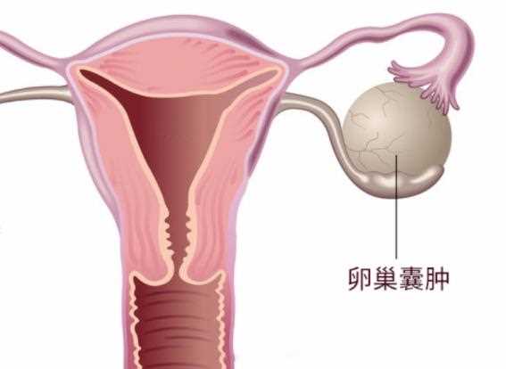 卵巢囊肿可以治好吗 左侧卵巢囊肿怎么办