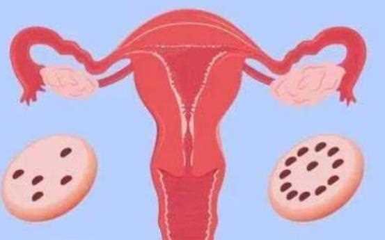 多囊卵巢综合征是怎么引起的