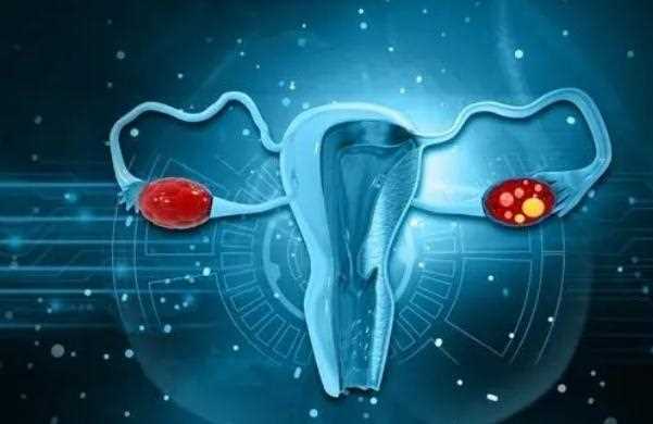 卵巢癌腹水怎么办？其他卵巢癌