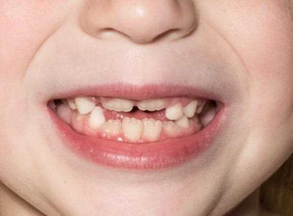 11岁小孩可以种植牙吗 孩子虫牙掉了怎么办
