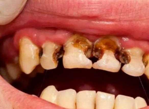 什么牙膏防蛀牙 儿童龋齿注意什么