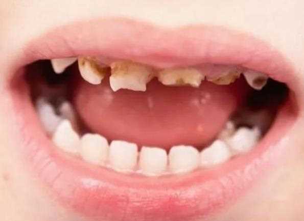 儿童龋齿不能吃什么 蛀牙吃什么比较好