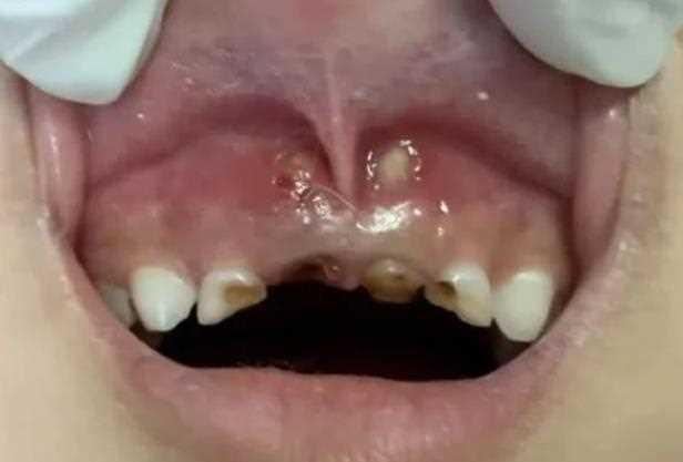 八岁孩子有虫牙需要补吗 外观出现龋洞疼痛及时补牙