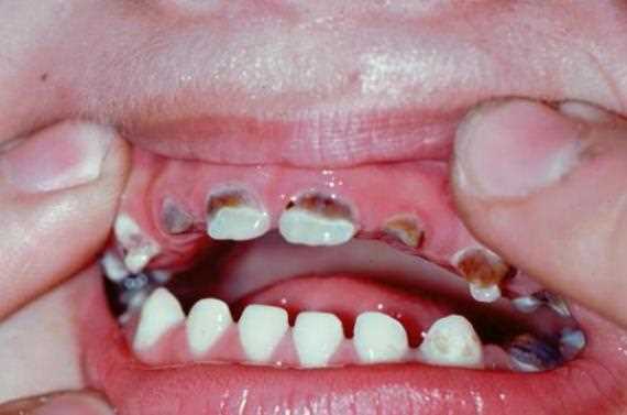 四岁宝宝蛀牙痛需要治疗吗 
