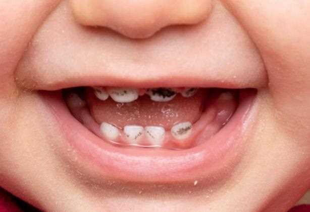 儿童虫牙是什么原因 吃糖不注重口腔卫生细菌感染