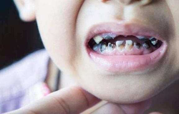 小孩虫牙牙痛怎么办 口服止痛药消炎药根管治疗