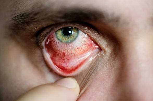 飞蚊症都是双眼吗 怎么防止飞蚊症加重