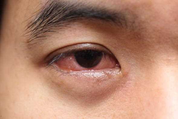 飞蚊症比干眼症严重吗 飞蚊症会导致失明吗