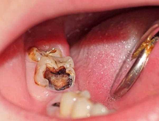急性牙髓炎可以拔牙吗 拔了智齿后就不会牙周炎了吗