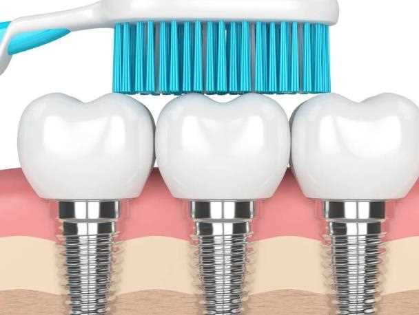 种植牙可以管一辈子吗 哪些因素影响种植牙的寿命