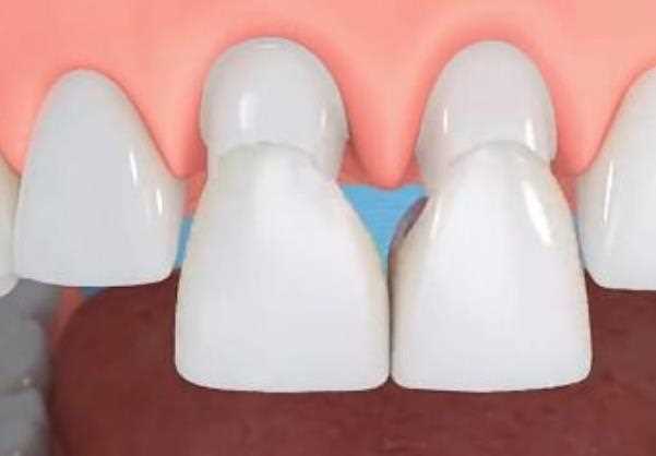 全瓷牙冠价格是多少 如何选择全瓷牙材料
