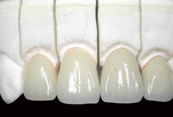 牙齿松动可以做烤瓷牙吗 牙龈萎缩可以做烤瓷牙吗