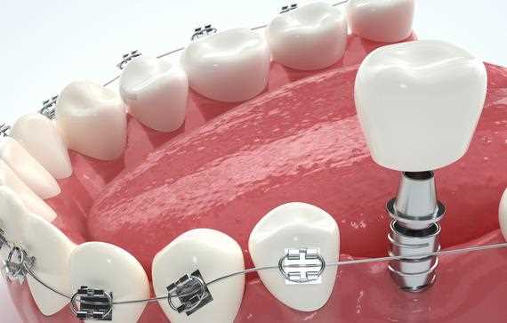 烤瓷牙可以做核磁共振吗 烤瓷牙和全瓷牙有副作用吗