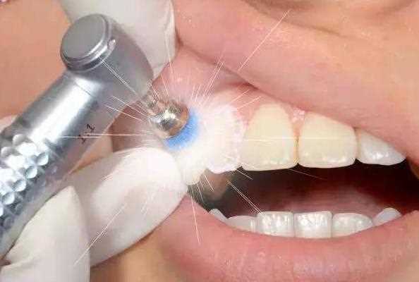 多久洗一次牙最合适 牙周病多久洗牙一次
