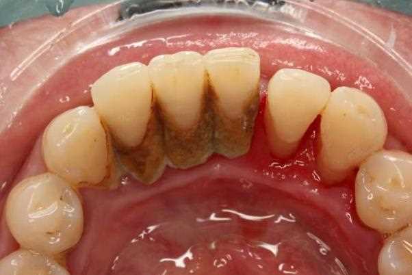 氟斑牙可以进行超声波洗牙吗