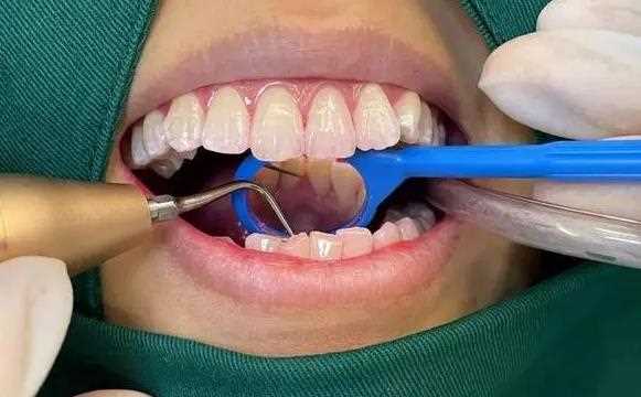 洗牙挂什么科 洗牙挂牙周病科吗